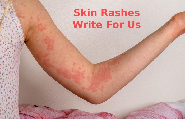 Skin Rashes Write For Us